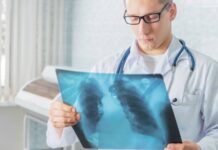 El cáncer de pulmón podría provocar la muerte de 160.000 latinoamericanos en 10 años